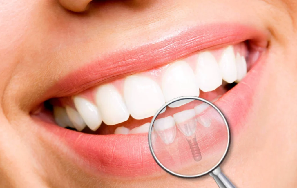 Chirurgie de la gencive péri-implantaire