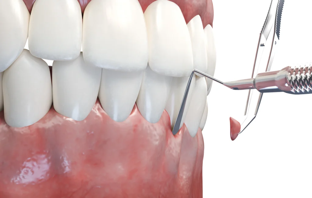 Chirurgie muco-gingivale