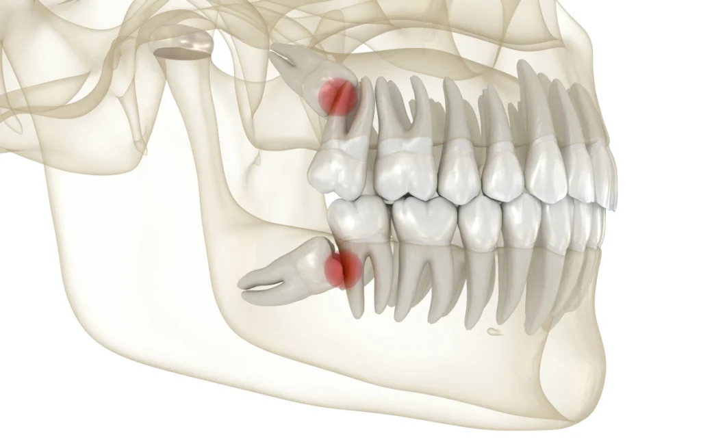 Extractions dentaires