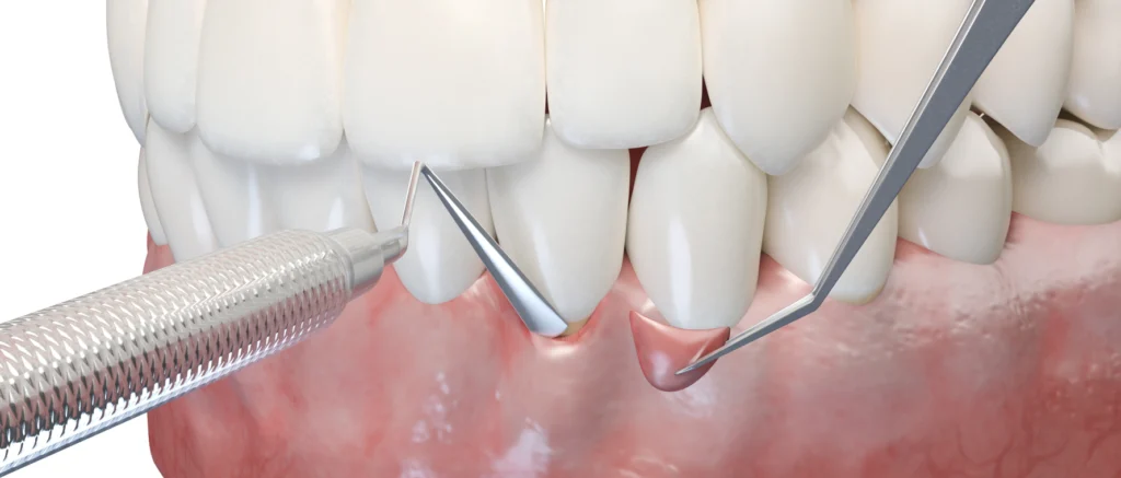 Chirurgie muco-gingivale