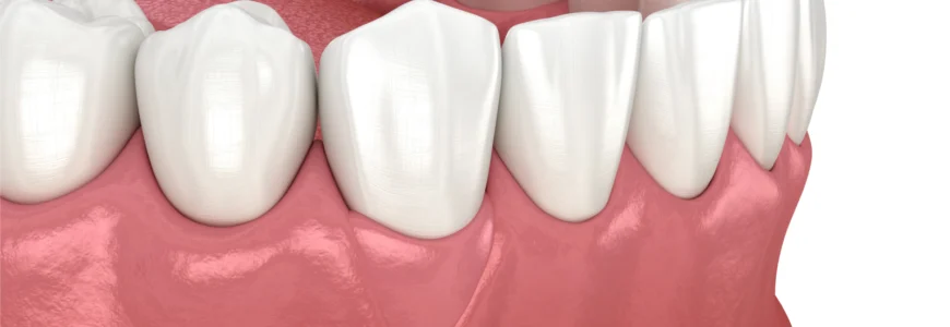 Chirurgie muco-gingivale