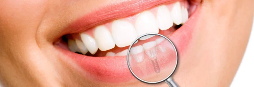 Chirurgie de la gencive péri-implantaire