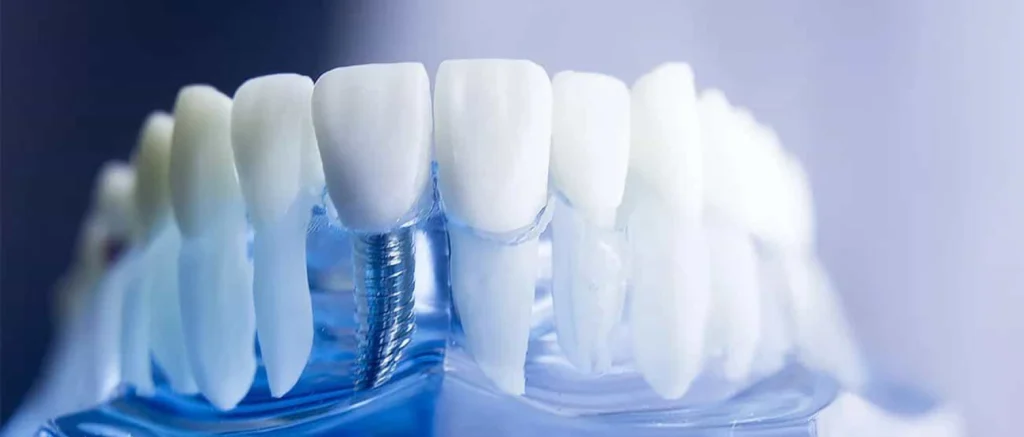 Implant : secteur antérieur et postérieur