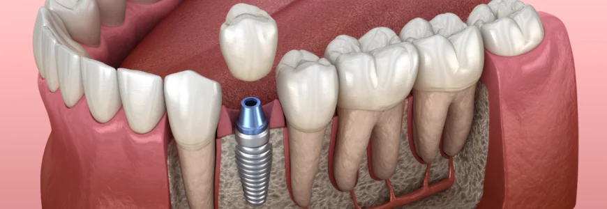 Implant : secteur antérieur et postérieur