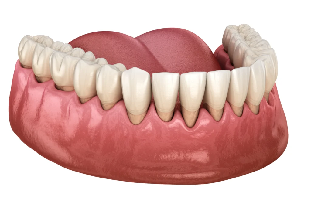 Déchaussement des dents