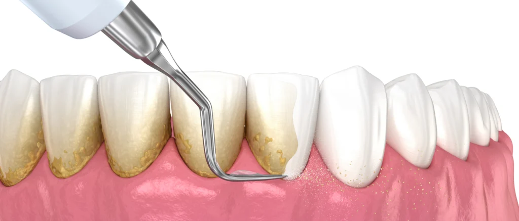 détartrage avant le traitement de gingivite ou parodontite