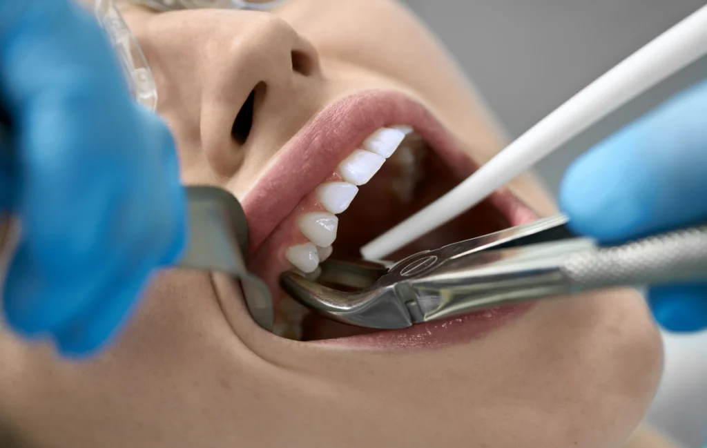 Implant dentaire immédiat