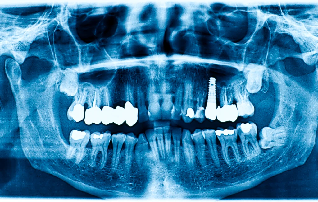 Implant dentaire
