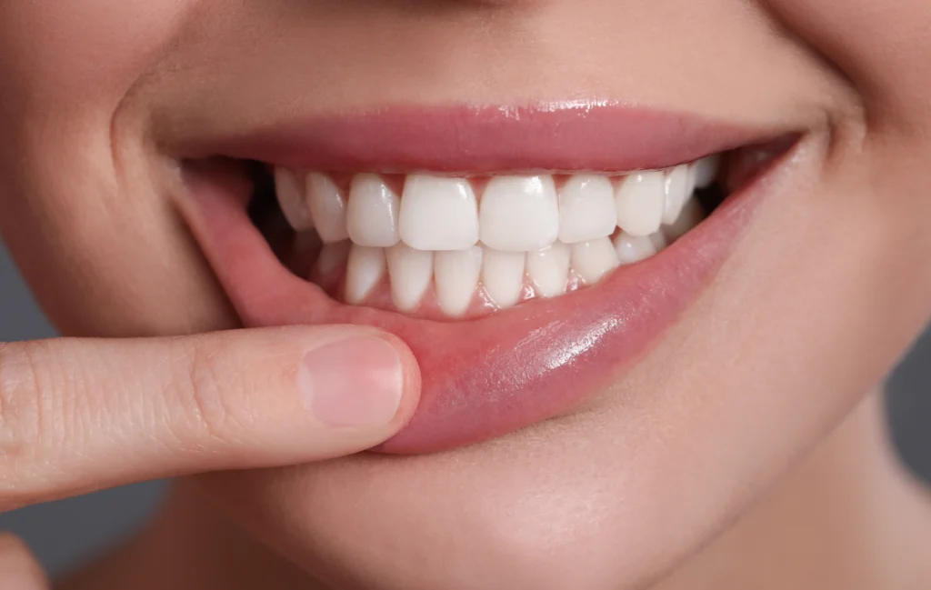 sourire après le traitement de maladies de gencives comme gingivite et parodontite