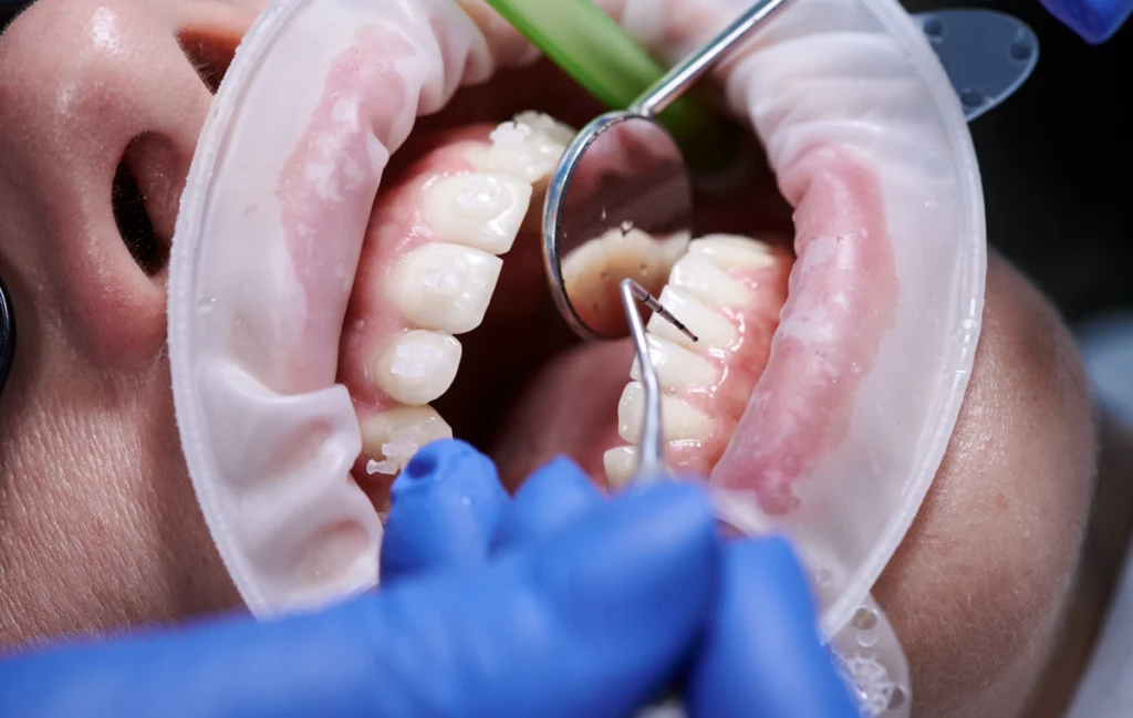 Gingivite, parodontite et autres maladies de gencives