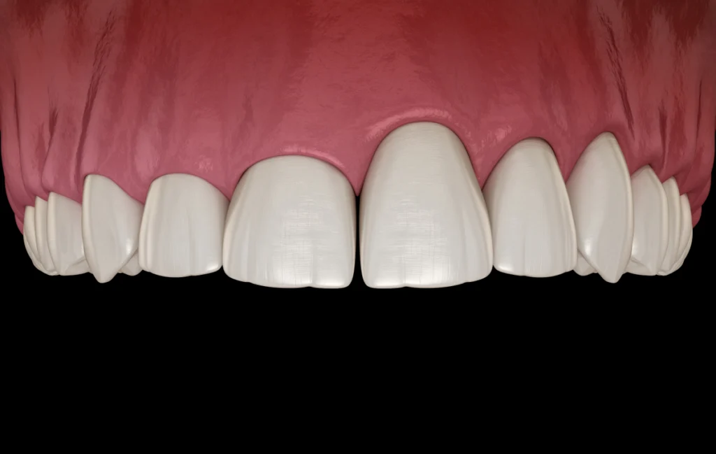 Élongation coronaire