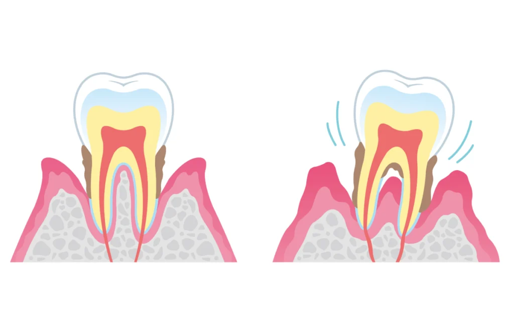 Déchaussement des dents