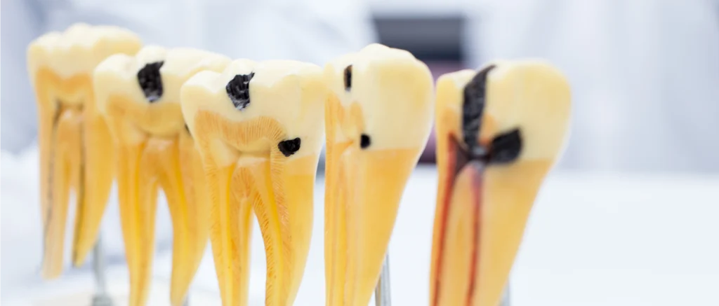 Extractions dentaires