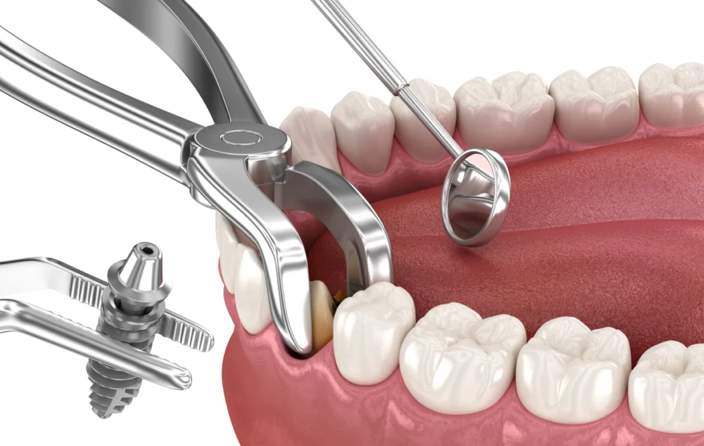 Implant dentaire immédiat