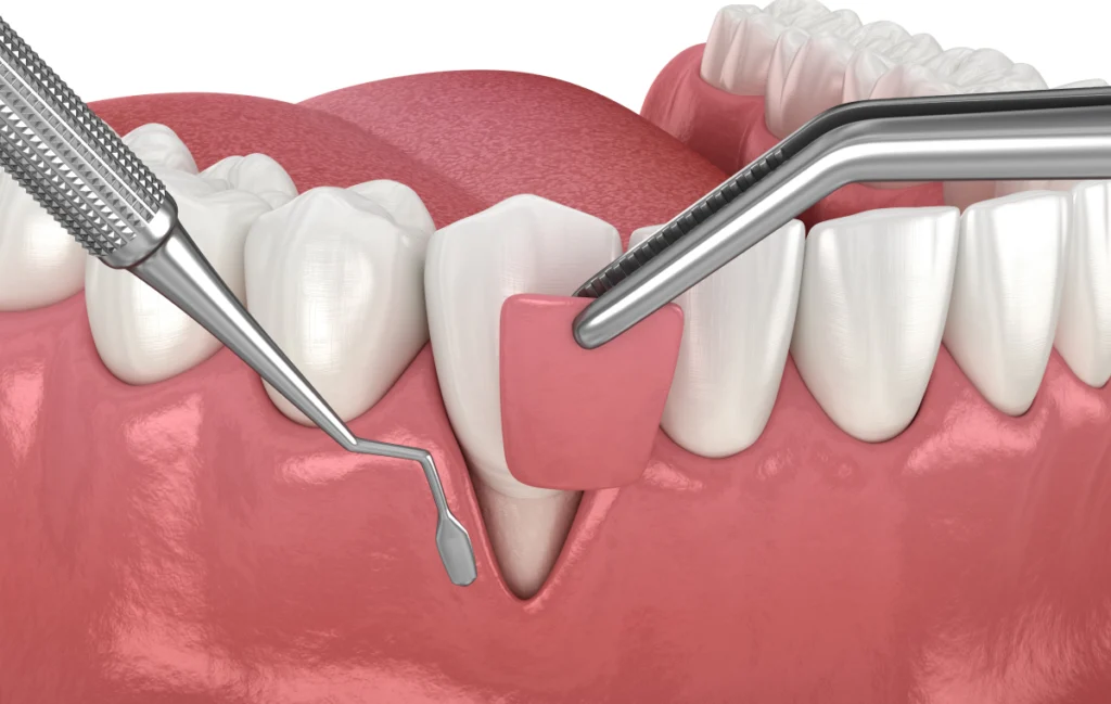 Chirurgie de la gencive péri-implantaire