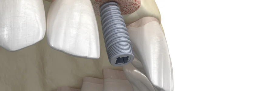 Greffe osseuse d'apposition