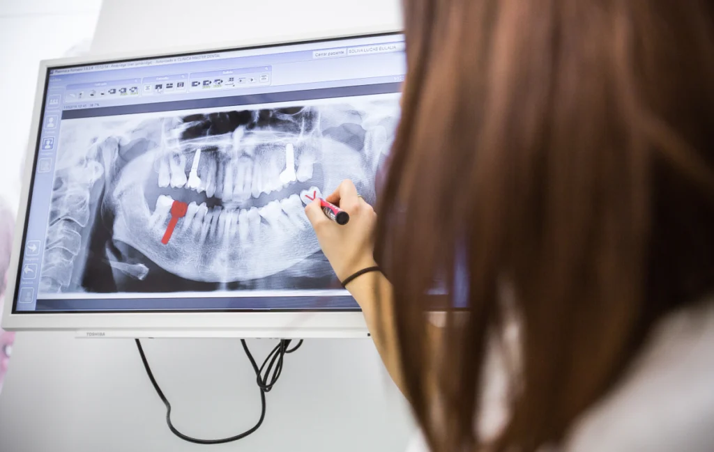 Implant dentaire immédiat